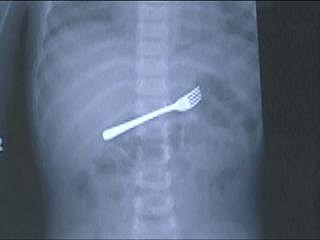 x-ray fork